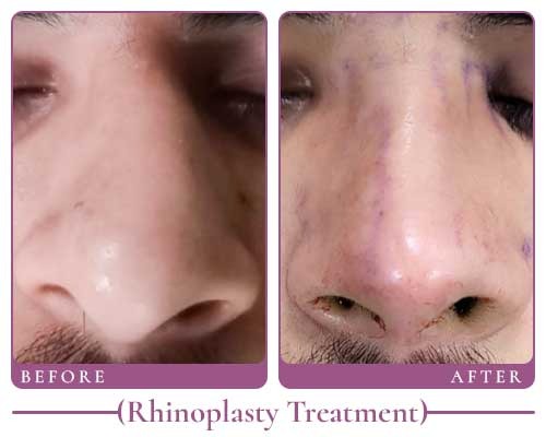 dr saloni rhino results