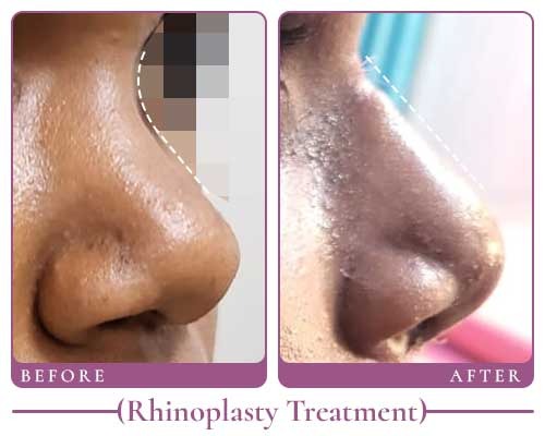 dr saloni rhino results