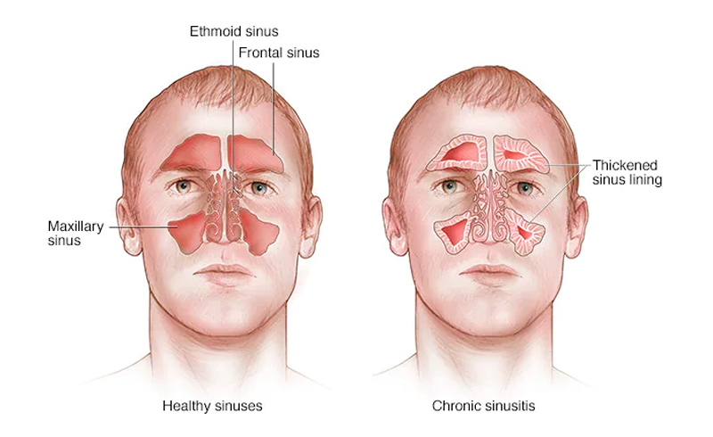 Chronic Sinus Infection