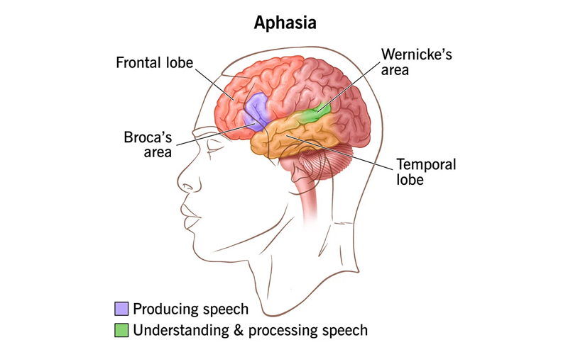 What is Aphasia? What are the causes, symptoms and treatment?